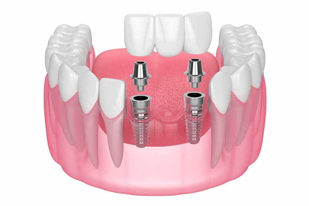 Jaw with implants supporting dental bridge