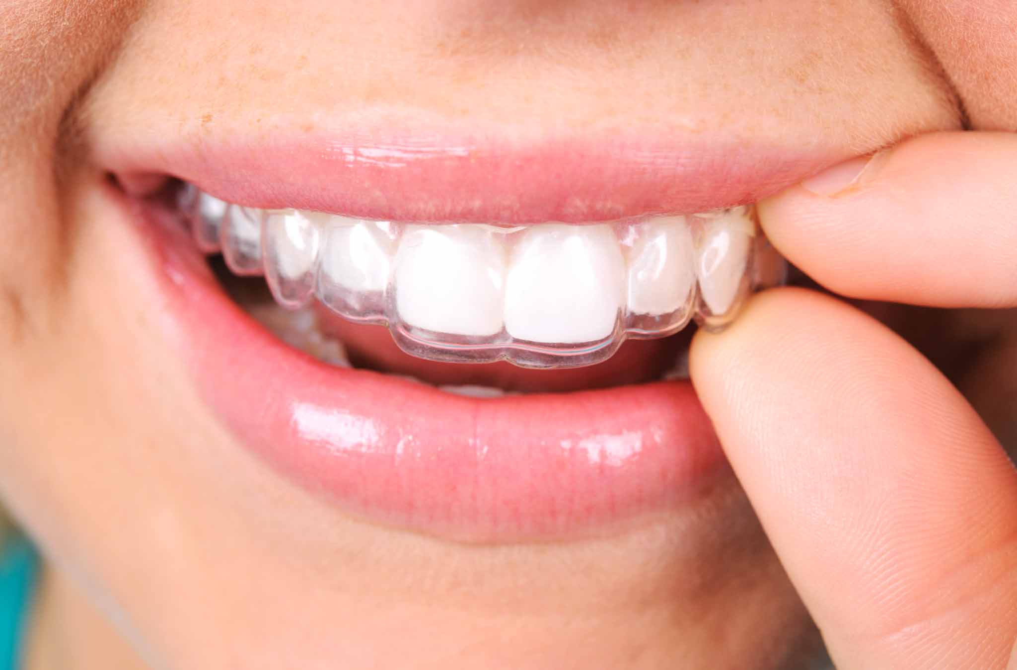 Close up of a person putting in clear aligners